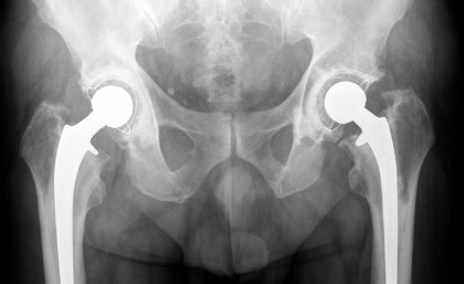 Increased fractures linked to common treatment. Increased fractures linked to common treatment.